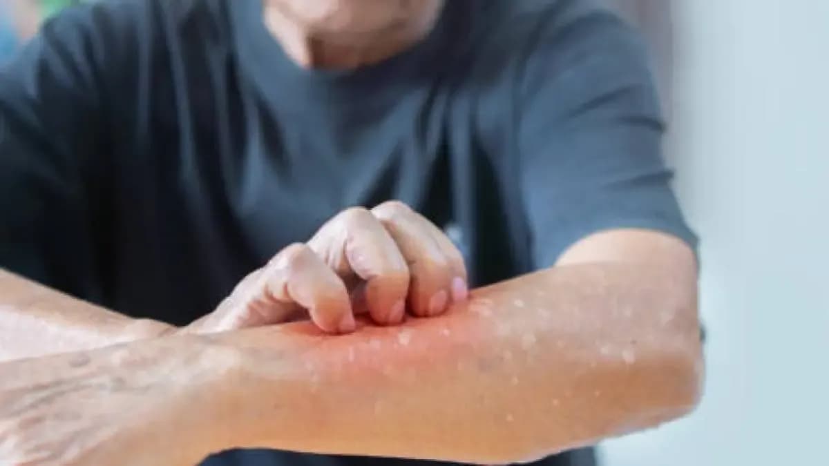 Cuarto caso de sarampión en Colombia: qué significa y por qué el Gobierno refuerza controles