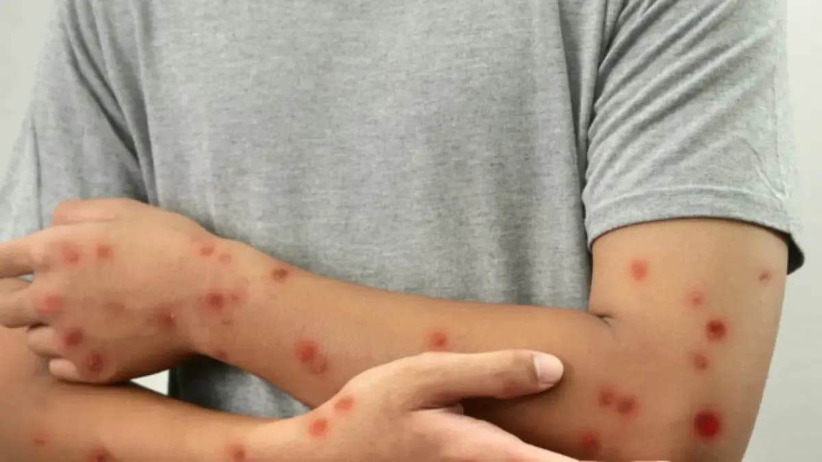 Bogotá confirma primer caso de sarampión: alertan sobre riesgo de propagación si baja la vacunación