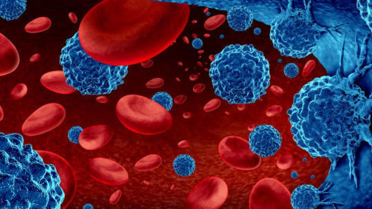 Mieloma múltiple: el cáncer de sangre que crece en Colombia y se diagnostica muy tarde