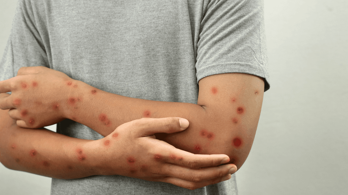 Bogotá activa alerta máxima tras detectar caso importado de sarampión desde México