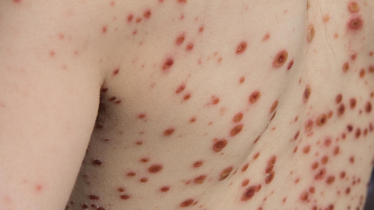 Varicela crece 15% en Colombia: qué regiones reportan más casos y qué hacer