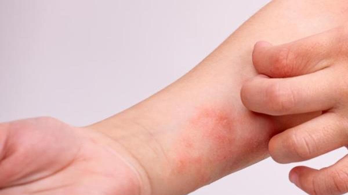 Colombia confirma tres casos de sarampión importado y activa protocolos ante el Mundial 2026