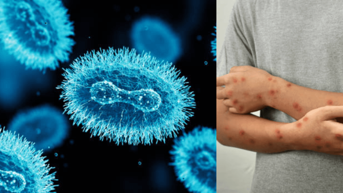 Colombia confirma segundo caso de mpox clado Ib en Bogotá sin transmisión comunitaria