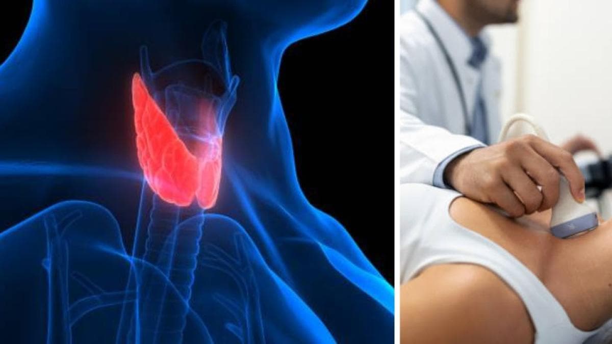 Nódulos en el cuello y ronquera: señales tempranas del cáncer de tiroides