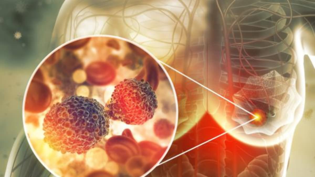 Prueba genómica incluida en el plan de salud permite decidir si pacientes con cáncer de mama necesitan quimioterapia