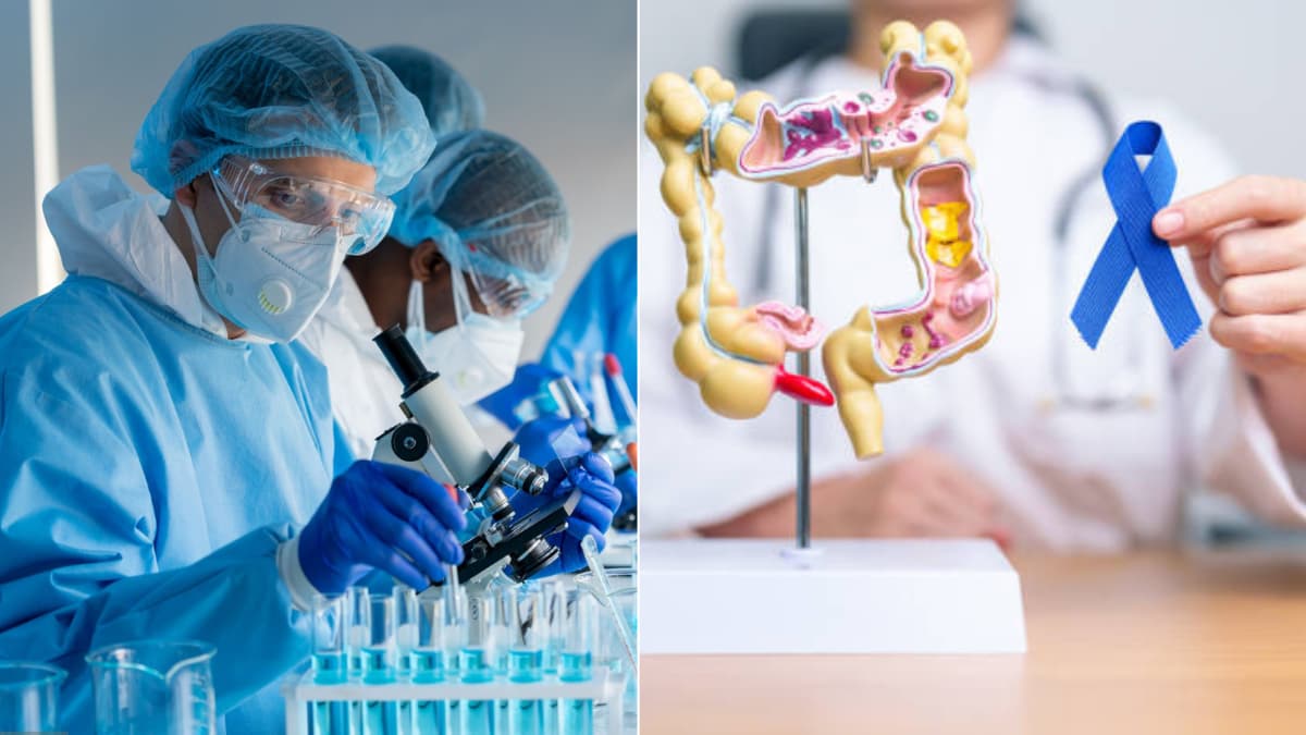 Argentina muestra el camino: cómo detectar el cáncer de colon antes de que se desarrolle