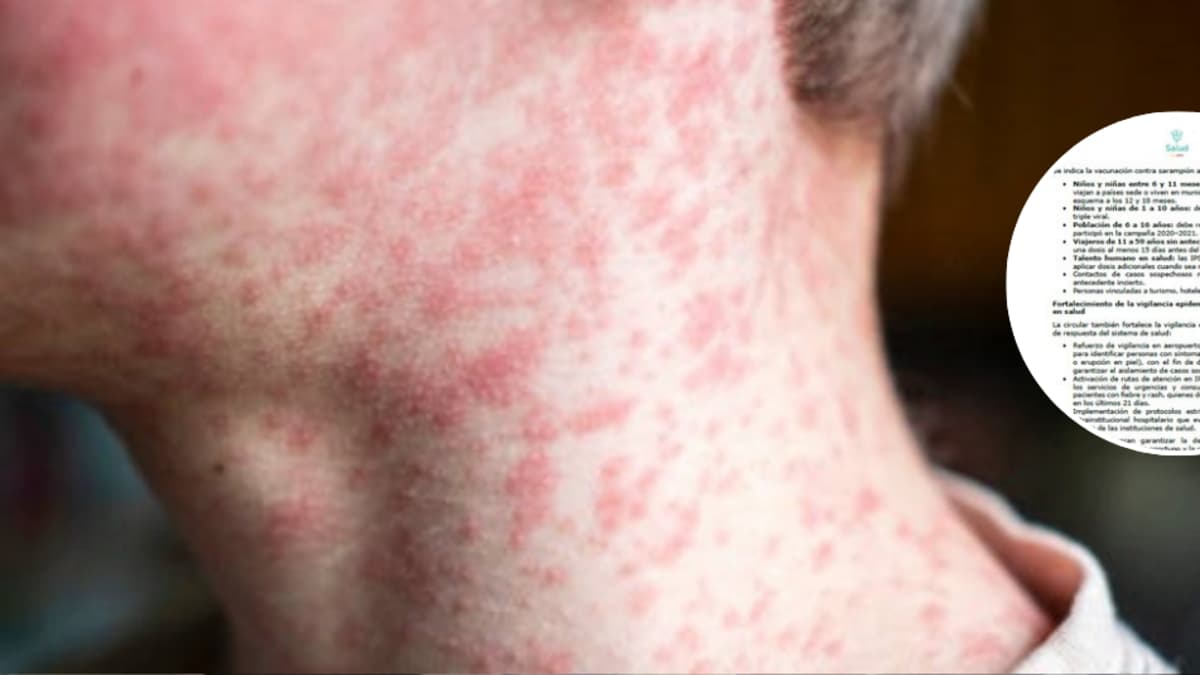 Colombia detecta tres casos importados de sarampión y refuerza vacunación ante alerta en América