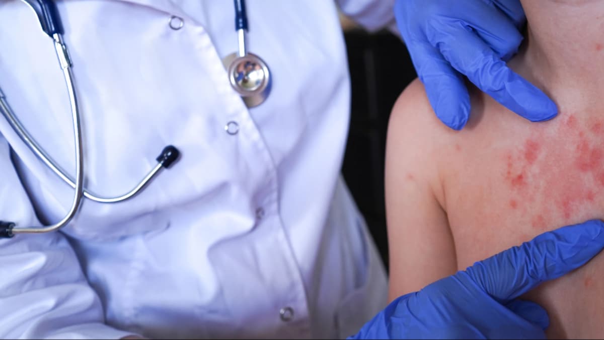 Bogotá ofrece su laboratorio para acelerar diagnóstico de sarampión tras casos importados