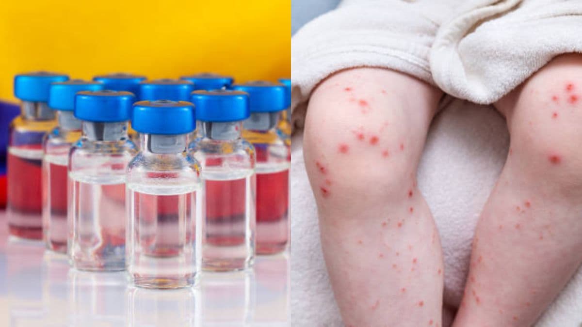 Sarampión en Colombia: cómo verificar si tiene las vacunas al día