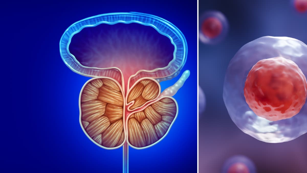 Prueba de imagen revolucionaria podría reducir a la mitad las biopsias de próstata
