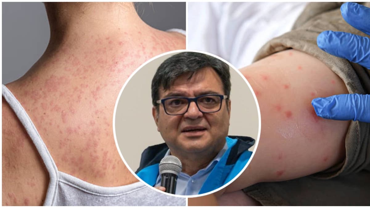 Bogotá enfrenta escasez de vacunas contra sarampión y concentra inmunización en aeropuerto