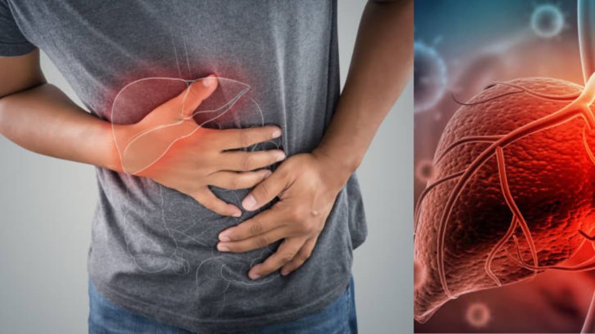 Reconozca a tiempo los síntomas de la cirrosis hepática para controlar la enfermedad