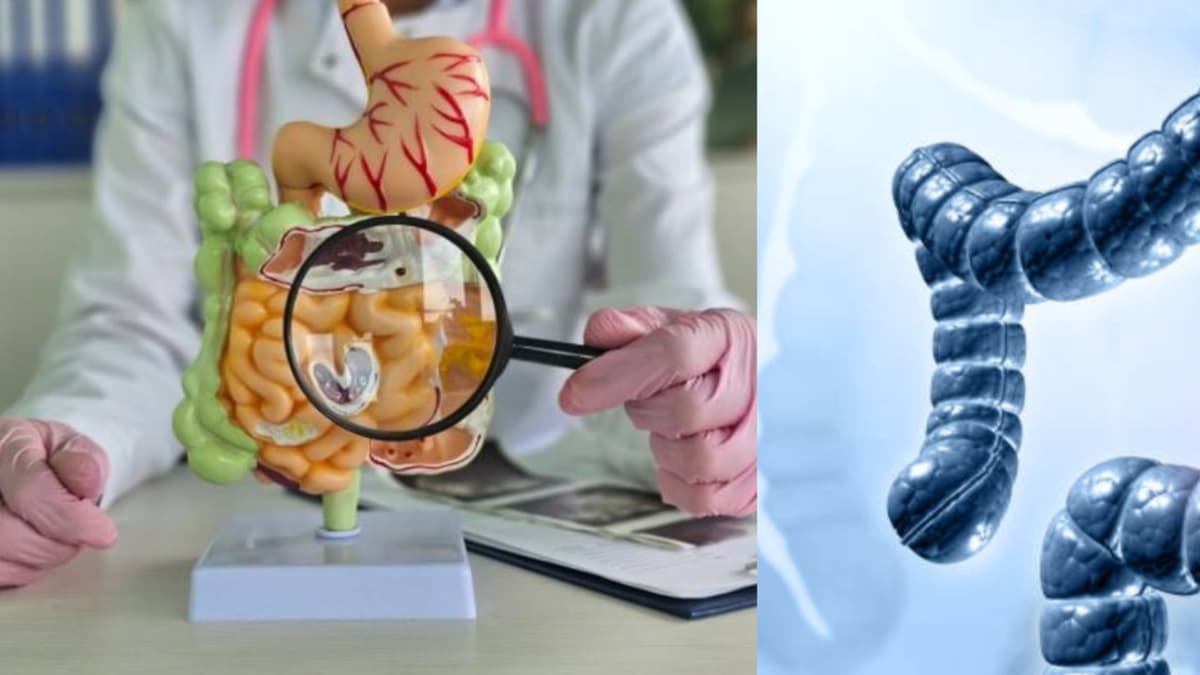 Cáncer de colon crece entre adultos jóvenes: esto es lo que está pasando