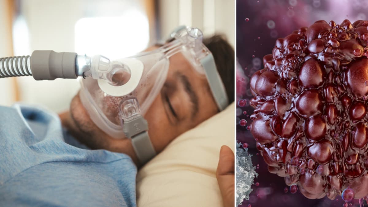 Apnea del sueño debilita defensas contra el cáncer, advierte especialista