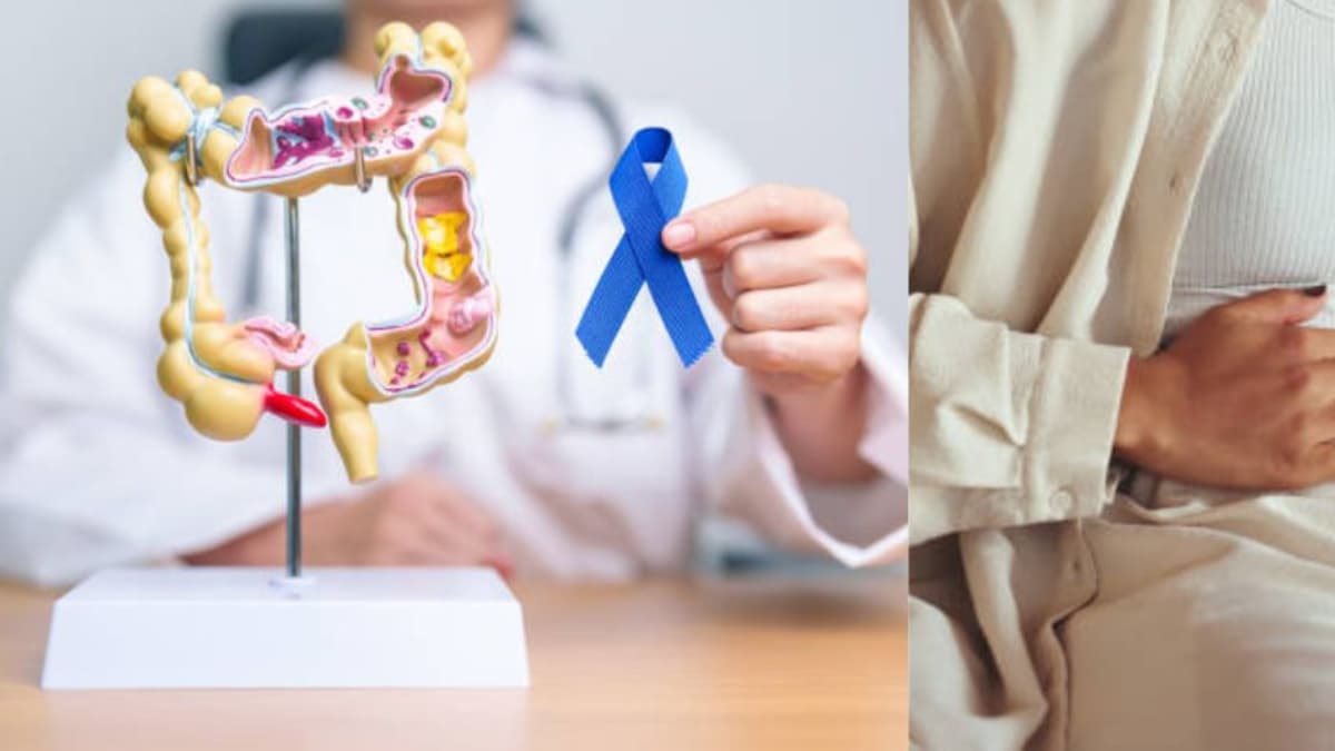 Seis señales de alerta del cáncer de intestino que debe conocer para detectarlo a tiempo