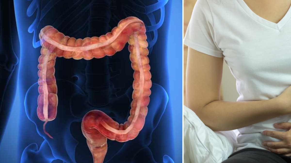 La inflamación intestinal deja marca en el ADN que aumenta riesgo de cáncer colorrectal