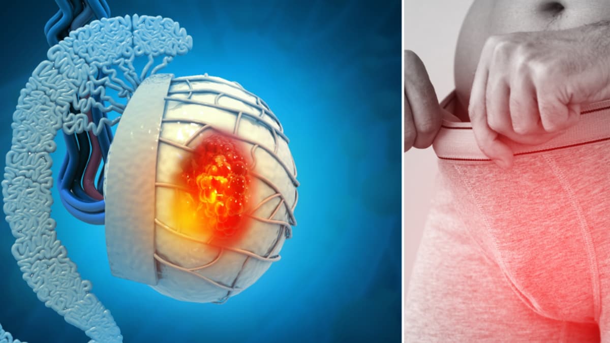 Cáncer testicular en jóvenes: cuatro señales de alerta que no debes ignorar