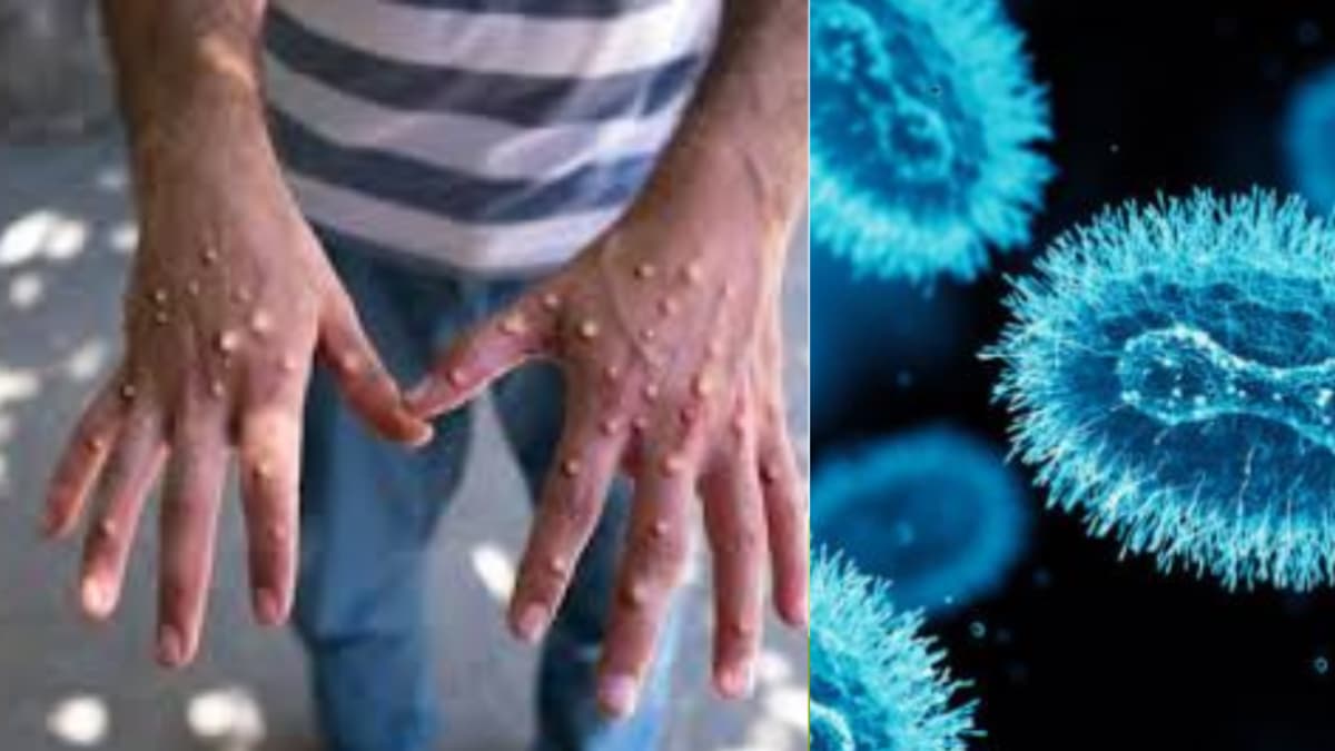 Colombia confirma primer caso de mpox clado 1B sin riesgo de transmisión comunitaria