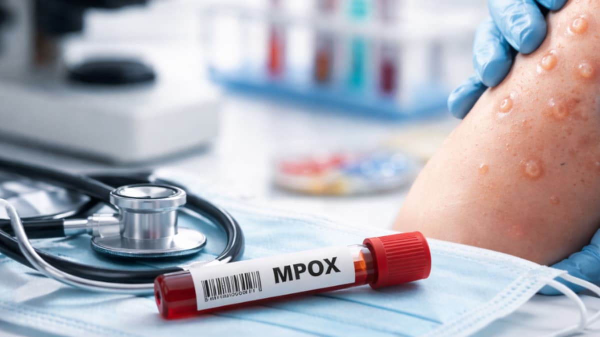 Colombia confirma primer caso de mpox clado Ib: qué es y cómo se contagia esta variante