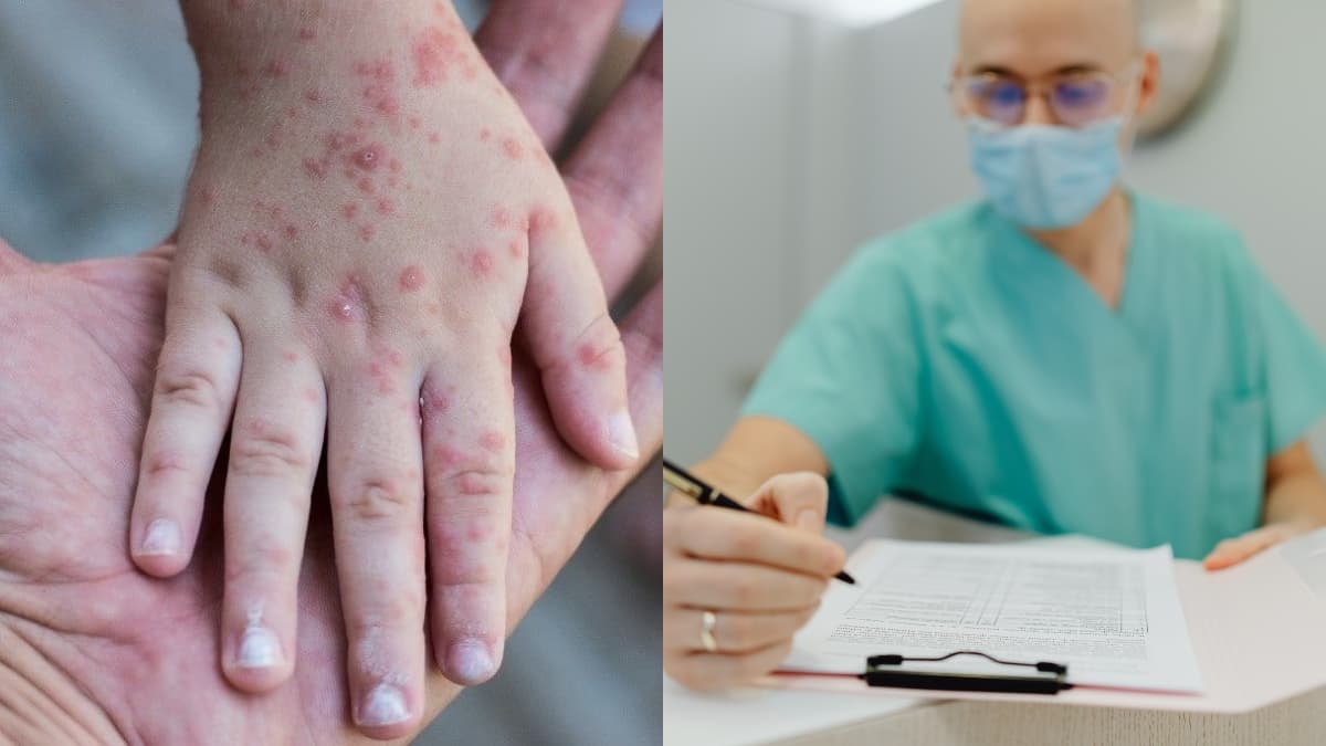 Colombia confirma primer caso de viruela símica clado Ib: qué síntomas vigilar y cómo prevenirse