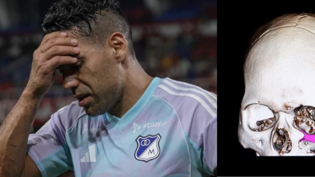 Fractura de arco cigomático: la lesión que sacó a Falcao del partido Millonarios vs América