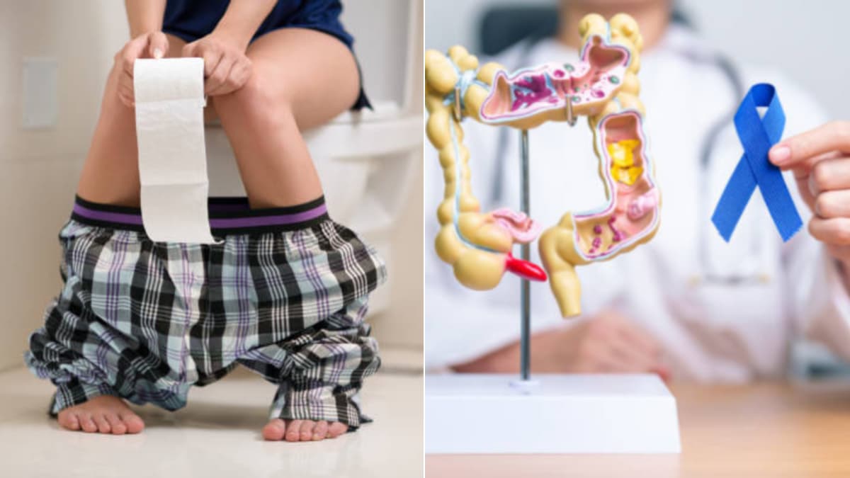 Cambios en las heces: señales de alerta que podrían indicar cáncer de colon
