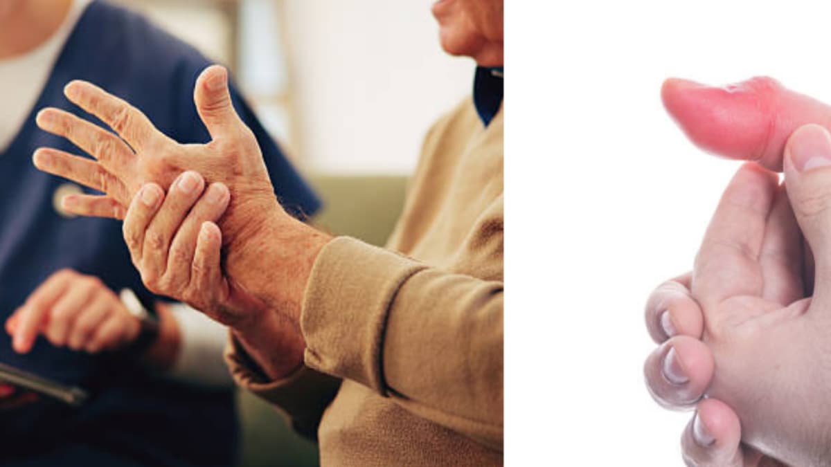 Señales que ignoras podrían advertirte sobre artritis: cómo detectarlas a tiempo