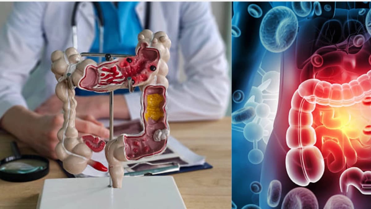 Cinco señales de alerta del cáncer de colon que pueden pasar desapercibidas