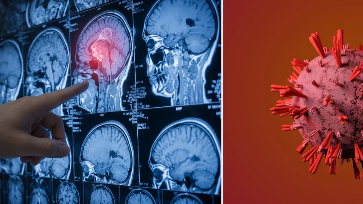 Cinco señales tempranas del cáncer cerebral que suelen confundirse con estrés