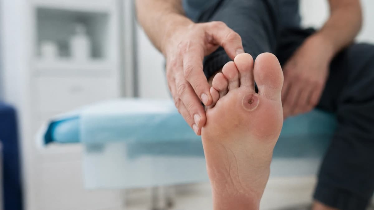 Una herida silenciosa en el pie: cómo la falta de sensibilidad puede llevar a la amputación