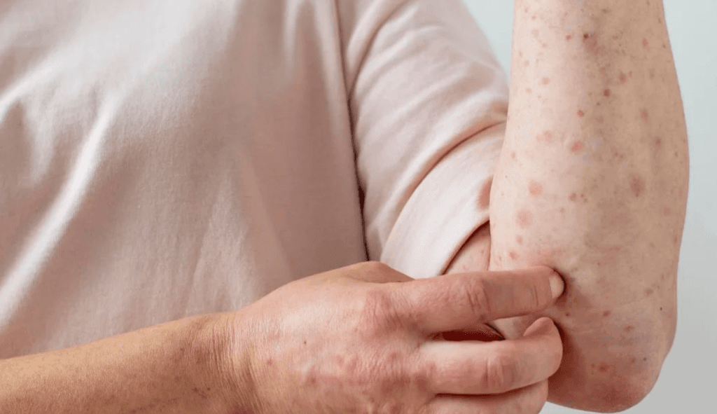 Quinta alerta de sarampión en Colombia: mujer regresó contagiada de Estados Unidos