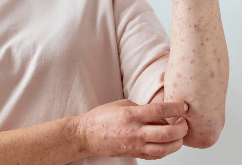 Quinta alerta por sarampión en Colombia: mujer contagiada en Estados Unidos