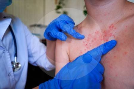 Colombia confirma tres casos de sarampión importado: MinSalud recomienda vacunarse antes de viajar a EE.UU., México y Canadá