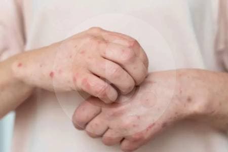 Colombia detecta primeros casos de sarampión importado; MinSalud pide refuerzo de vacunas para viajeros