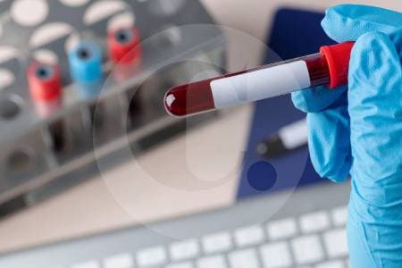 Crean test de sangre que detecta cáncer de páncreas en minutos: así funciona
