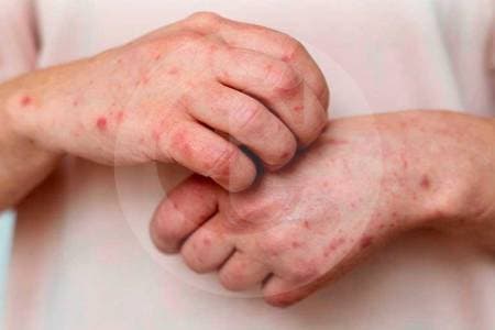 Confirman segundo caso de viruela símica en Bogotá: autoridades activan alerta epidemiológica