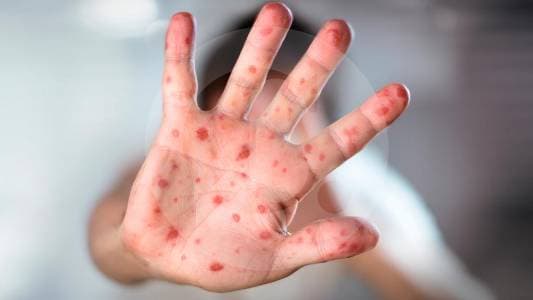 Sarampión: qué debes saber sobre síntomas, vacunación y medidas en Colombia
