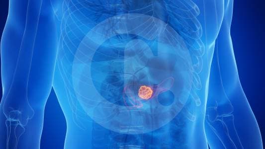 Después de 40 años sin avances, el cáncer de páncreas empieza a ceder ante nuevos tratamientos
