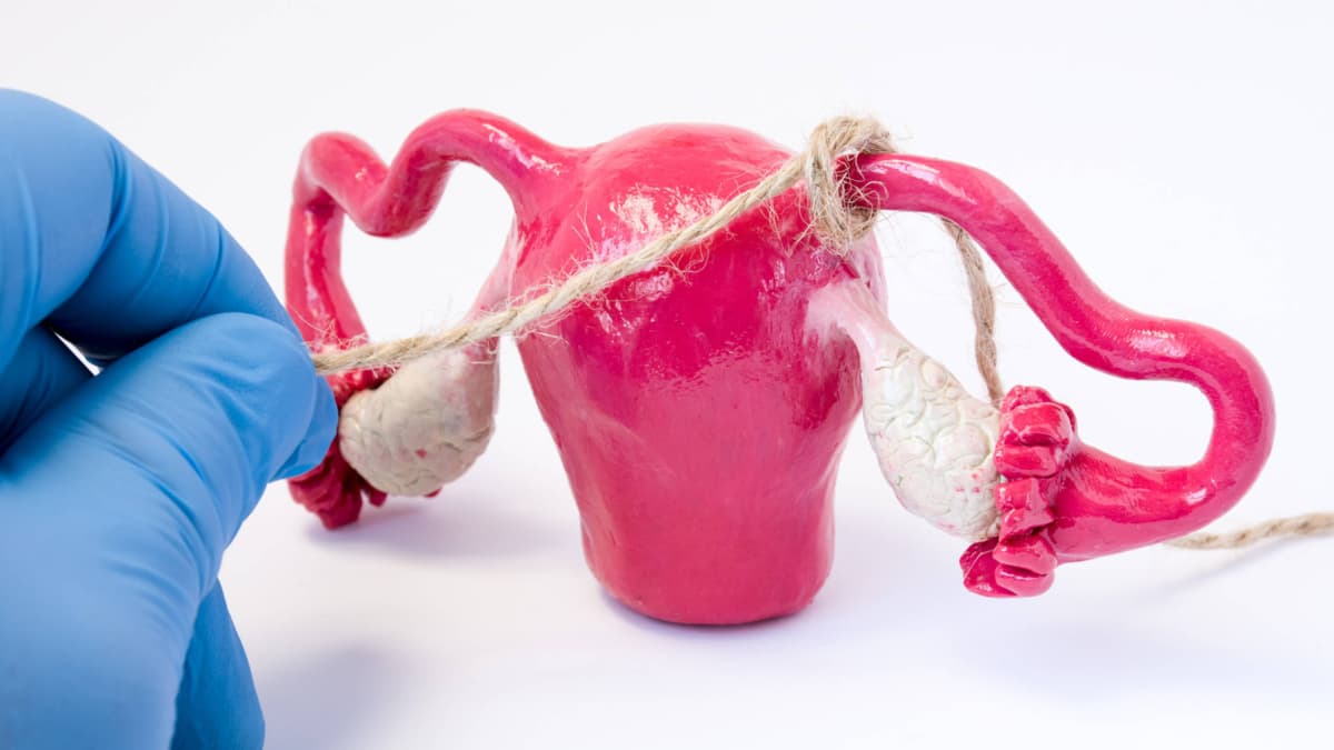 Reversión de ligadura de trompas por EPS: no es automática, depende de varios factores