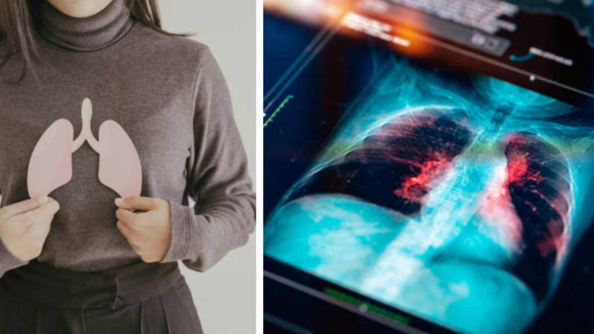 Cinco síntomas que no debe ignorar: cuándo una tos puede indicar cáncer de pulmón