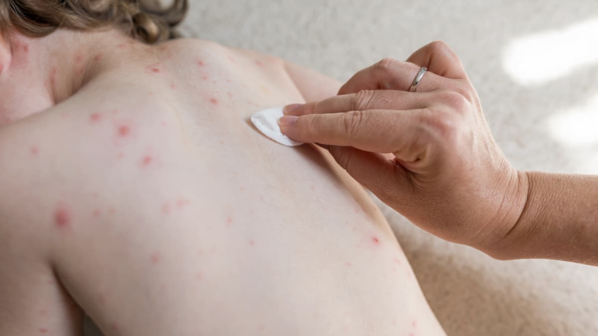 Cartagena activa cercos sanitarios por regreso del sarampión tras seis años sin casos