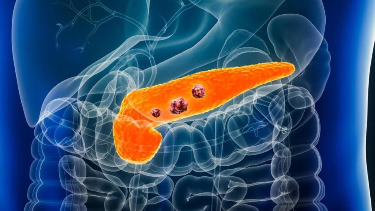 Científicos crean test de sangre que detecta cáncer de páncreas en minutos