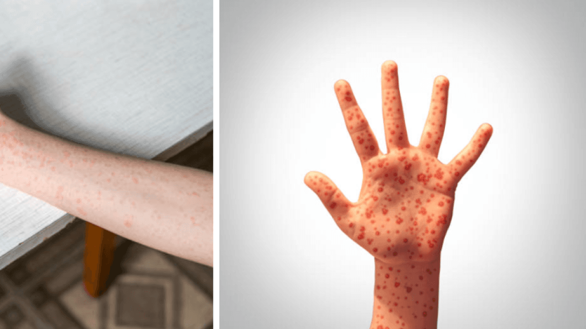 Colombia en alerta por cuatro casos sospechosos de sarampión importados del exterior