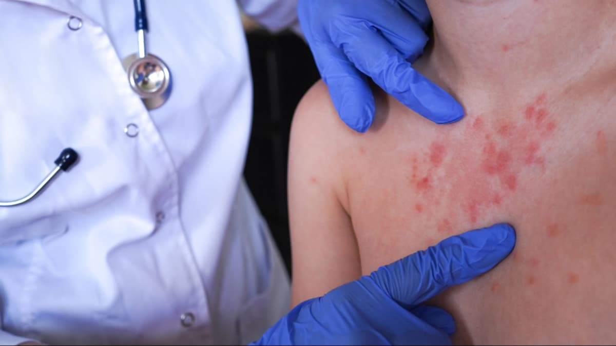 Cuatro casos de sarampión importado alertan a Colombia: autoridades piden reforzar vacunación