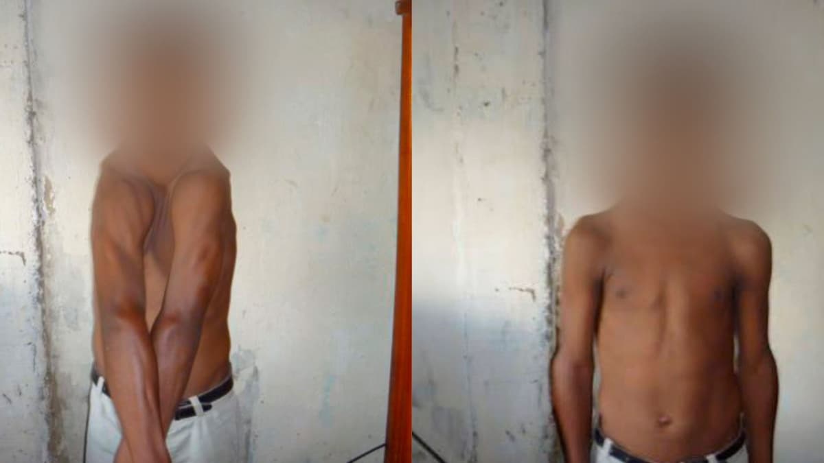 Universidad de Cartagena logra que rara enfermedad genética sea reconocida oficialmente en Colombia