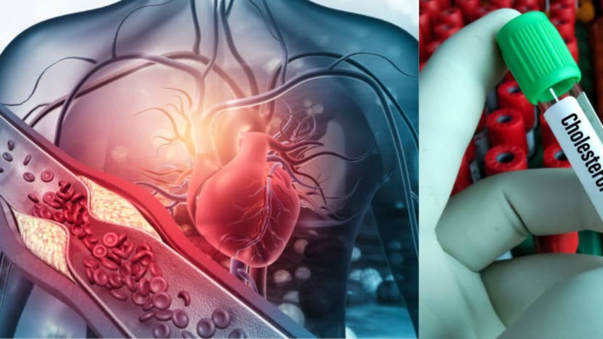Medicina actualiza límites de colesterol según el riesgo de cada paciente para prevenir infartos
