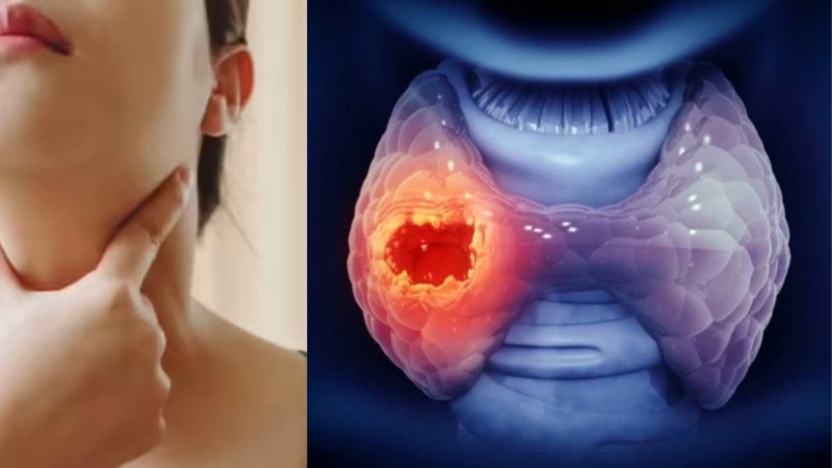 Hipotiroidismo e hipertiroidismo: qué síntomas debe vigilar toda mujer colombiana después de los 40