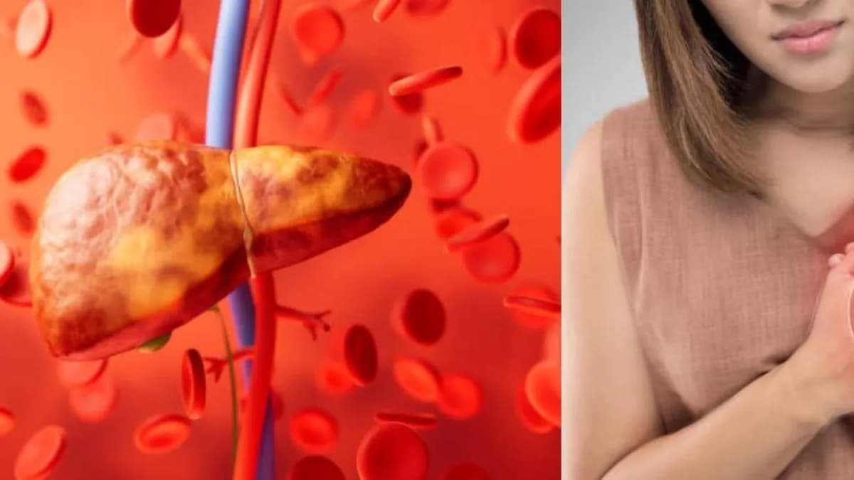 Hígado graso aumenta 69 % el riesgo de infarto y otras enfermedades del corazón