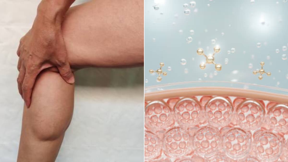 Lipedema: la enfermedad que afecta a millones de mujeres y se confunde con celulitis