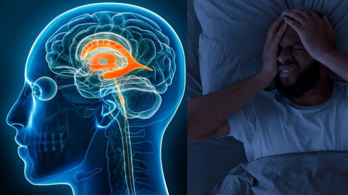 Un dolor de cabeza que mejora acostado podría alertar sobre hipotensión intracraneal
